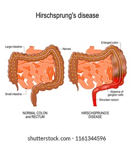 Die Hirschsprung-Krankheit ist ein Geburtsfehler (Nerven fehlen aus Teilen des Darms). Verstopfung. Abbildung stellt den menschlichen Darm (groß und klein) dar.   Vektorgrafik