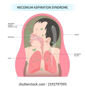Hirschsprung's Meconium aspiration syndrome in fetal care and womb