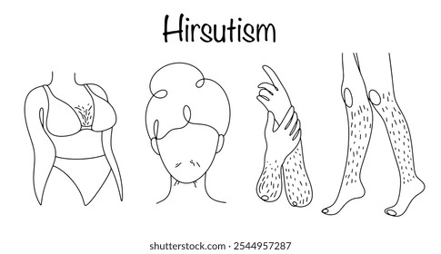 Hirsutismo. Sintoma de patologia do sistema endócrino, caracterizado por excesso de pelos na face e outras partes do corpo em mulheres. Sintomas de hirsutismo desenhados à mão. Ilustração vetorial.