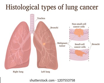 Histological types of lung cancer - small cell and non-small cell