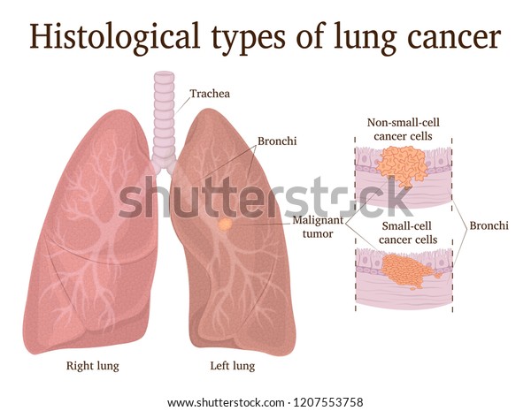Histological Types Lung Cancer Small Cell Stock Vector (Royalty Free ...