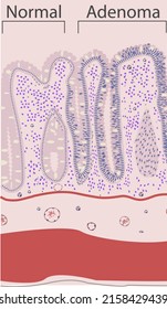 Histology Of Adenola Of Colon With Normal, Vector, Illustration