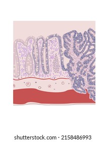 Histology Of Colorectal Carcinoma, Vector, Medical Illustration