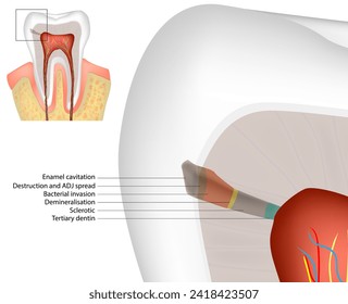 Histopathology of Caries in Enamel and Dentine. Enamel Dentin Pulp complex. Diagram Dental Caries. Tertiary dentine