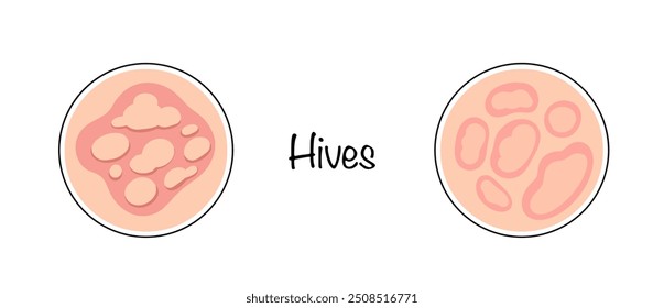 Urticária. Um tipo de alergia, cujos principais sintomas são bolhas na pele e coceira grave. Manifestações puxadas à mão da doença na pele. Ilustração do vetor de cores.