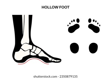 Hollow feet medical poster. Abnormal feet arch condition, overpronation, foot deformation and body balance problem. Ankle pathology diagnostic, treatment in podiatry clinic vector illustration