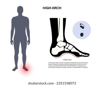 Hollow feet medical poster. Abnormal feet arch condition, overpronation, foot deformation and body balance problem. Ankle pathology diagnostic, treatment in podiatry clinic vector illustration