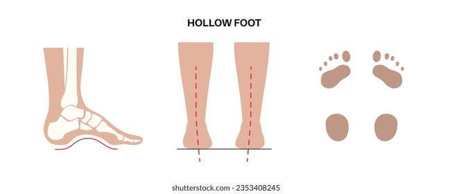 Hollow feet medical poster. Abnormal feet arch condition, overpronation, foot deformation and body balance problem. Ankle pathology diagnostic, treatment in podiatry clinic vector illustration