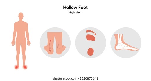 Hollow foot and footprint. Hight arch. Orthopedist diagram infographic