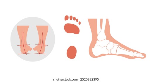 Hollow foot and footprint. Orthopedist diagram infographic