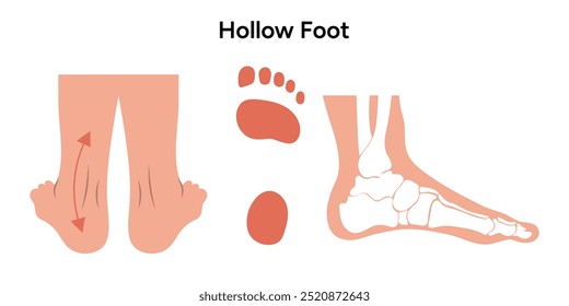 Hollow foot. Orthopedist diagram infographic