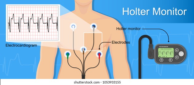 Holter monitoring system tracking cardio problem failure sick irregular disorders transducer therapy cardioversion heartbeat non invasive diagnosis treat