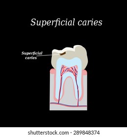 Home tooth caries. Vector illustration on a black background.