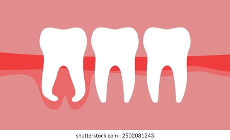 Hooked wisdom tooth root, flat color illustration