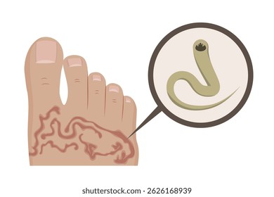 Hookworm causing cutaneous larva migrans infection in human foot