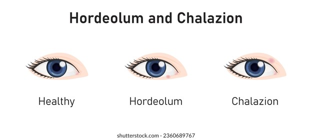 Hordeolum and Chalazion Concept Design. Vector Illustration.