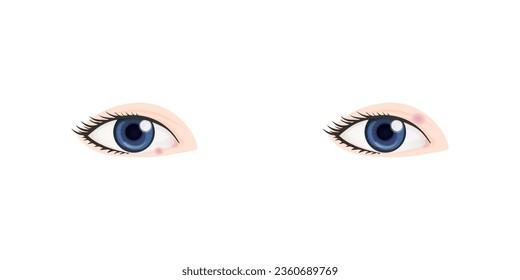 Hordeolum und Chalazion Concept Design. Vektorgrafik.