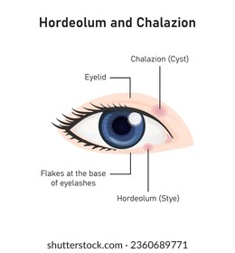 Diseño conceptual de Hordeolum y Chalazion. Ilustración vectorial.