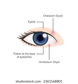 Hordeolum und Chalazion Concept Design. Vektorgrafik.