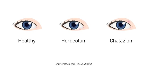 Hordeolum and Chalazion Concept Design. Vector Illustration.