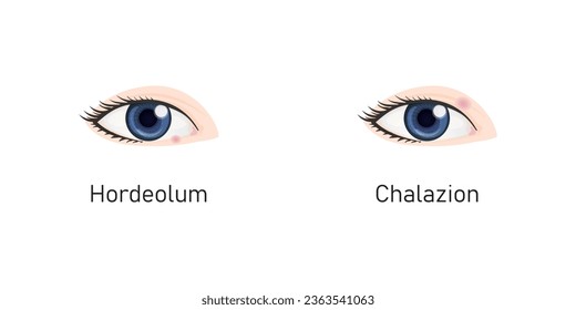 Hordeolum and Chalazion Concept Design. Vector Illustration.