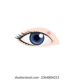 Hordeolum Concept Design. Vector Illustration.