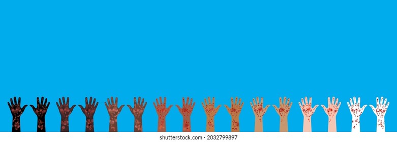 Horizontal banner. 8 pairs of hands raised up. Hands of different races and skin colors. Palms up. Painful rash covers skin. Vector illustration of skin diseases and manifestations of illness signs.