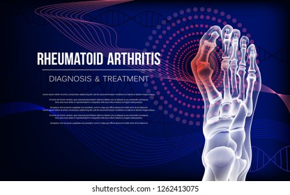 Horizontal dark blue banner for arthritis advertising, medical publications. Rheumatoid artritic sore joints concept. Realistic bones of foot skeleton of human leg. Vector illustration stock.