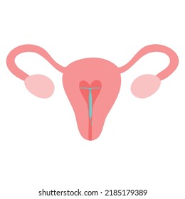 Hormonal IUD. Copper Intrauterine Device Colored Flat Style Icon. Women Contraceptive Birth Control Methods. Female Contraception.