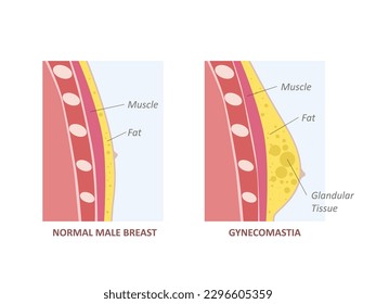 Hormone imbalance between estrogens and androgens. Gynecomastia