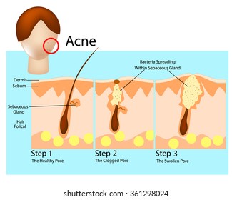 How acne develops. Acne stages. Formation of skin acne or pimple