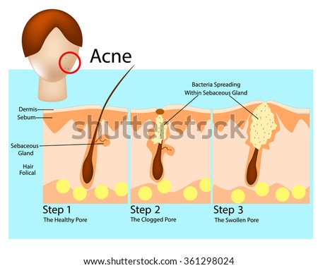 how acne develops acne stages formation stock vector royalty free