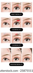 How to Blepharoplasty of eyelid step vector illustration