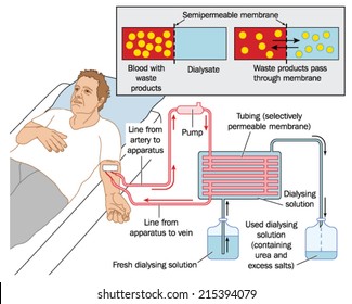 How Blood Dialysis Works, Showing A Patient Connected To A Blood Pump, Semipermeable Membrane And Dialysing Solution. Created In Adobe Illustrator.  EPS 10.