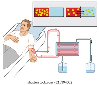 How blood dialysis works, showing a patient connected to a blood pump, semipermeable membrane and dialysing solution. Created in Adobe Illustrator.  EPS 10.