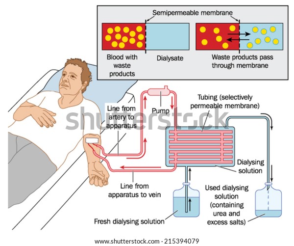 血液透析の仕組み 血液ポンプに接続された患者 半透膜 透析液を示す Adobe Illustratorで作成 Eps10 のベクター画像素材 ロイヤリティフリー