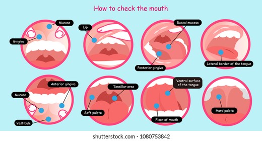 Oral Cancer Images Stock Photos Vectors Shutterstock