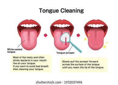 How to clean your tongue vector illustration (Halitosis prevention)