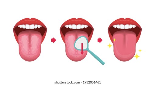 How to clean your tongue vector illustration (Halitosis prevention)