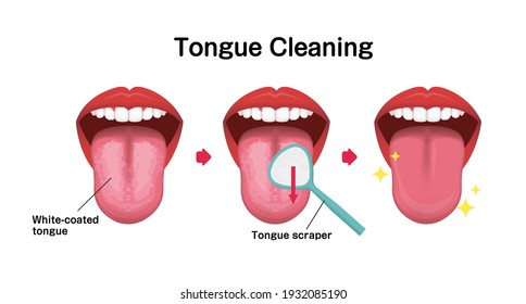 Wie reinigen Sie Ihre Zungenvektorgrafik (Halitose-Prävention)