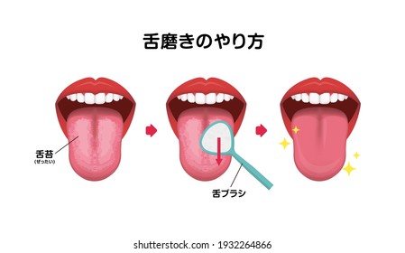 How to clean your tongue vector illustration (Halitosis prevention). Translation: How to clean your tongue, White-coated tongue, Tongue scraper.