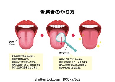 How to clean your tongue vector illustration (Halitosis prevention). Translation: How to clean your tongue, White-coated tongue, Tongue scraper.