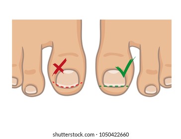 How to cut toe nails, right and wrong concept. How to avoid ingrown nail. Female or male foot sole, barefoot, top view. Vector illustration, hand drawn cartoon style isolated on white.