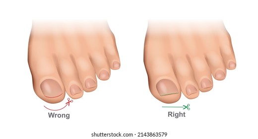 How to cut toenails correctly vector illustration. Proper and improper trimming of nails.Ingrown Toenails. Pedicure