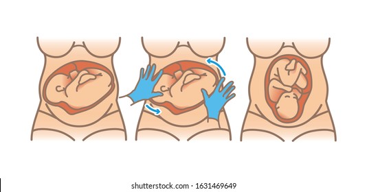 How Help Baby To Turn A Head Down Position In The Womb. Pregnancy