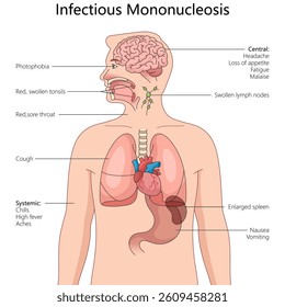 how infectious mononucleosis affects the body, including systemic, respiratory, digestive, and neurological symptoms diagram hand drawn schematic vector. Medical science educational illustration