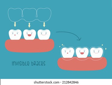 How to of invisible braces by tooth concept Illustrator