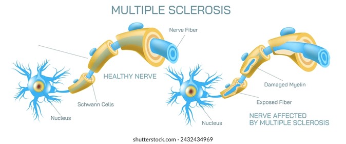 how neurotransmitter works? The process the brain neurons communicate each other anatomy vector illustration. Action potentials and synapses. multiple sclerosis formation. Motor neuron communication.