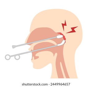 Durchführung und Veranschaulichung der Epipharyngealen Abrasivtherapie; B-Punkt-Therapie