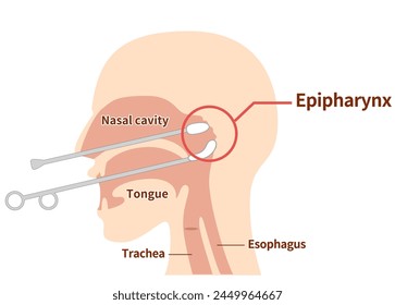 Durchführung und Veranschaulichung der Epipharyngealen Abrasivtherapie; B-Punkt-Therapie